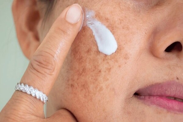 با منافذ باز پوست چه کنیم؟/ این منافذ به طور قطعی درمان می‌شوند؟