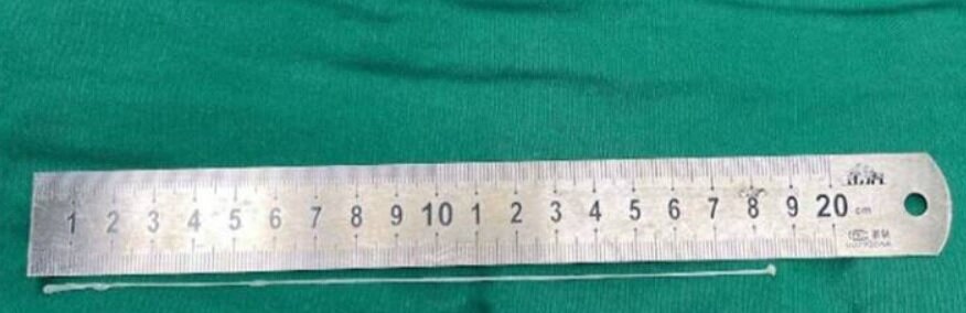 خارج کردن کرم ۱۸ سانتی‌متری از مغز یک مرد/ عکس