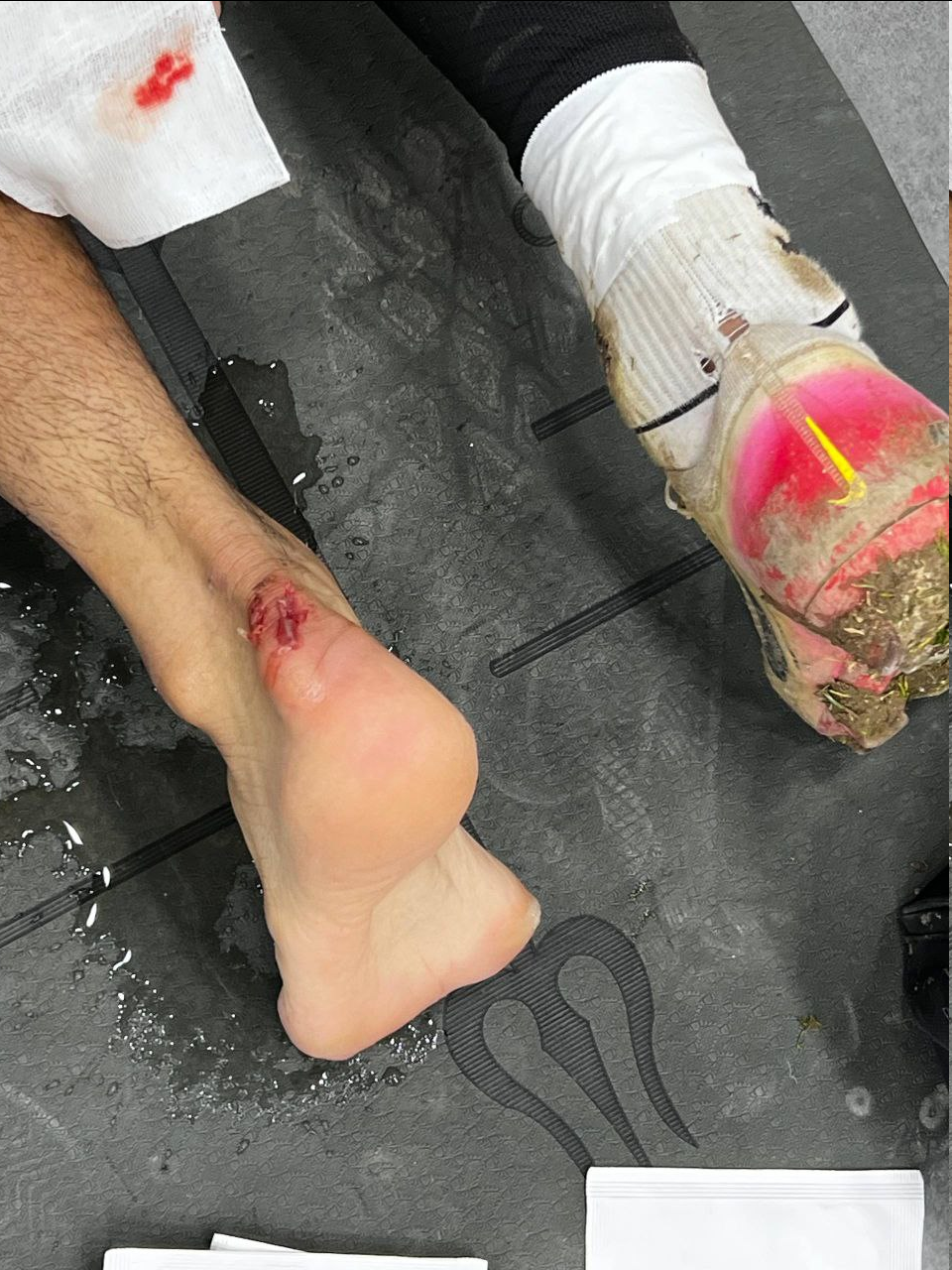 عکس| صحنه دلخراش از پای بازیکن خیبر/ کارت قرمز داشت؟