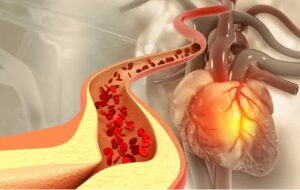 آیا باید از کلسترول و تری‌گلیسیرید بالا ترسید؟/ عوامل بالا برنده کلسترول و تری‌گلیسیرید خون را بشناسیم