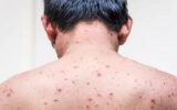 علائم شدید آبله‌مرغان در بزرگسالان؛ ضرورت درمان سریع و واکسیناسیون