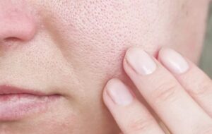 با منافذ باز پوست چه کنیم؟/ این منافذ به طور قطعی درمان می‌شوند؟