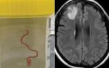 خارج کردن کرم ۱۸ سانتی‌متری از مغز یک مرد/ عکس