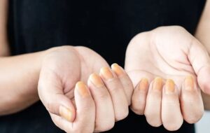 رنگ زرد ناخن نشانه چیست؟