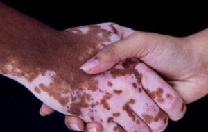 روشی برای کاهش لک‌های پوستی در ایران