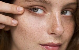 آشنایی با انواع لک‌های پوستی