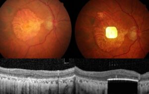 بازگشت بینایی با هوش‌ مصنوعی / ایمپلنت چشمی کوچک بینایی افراد مبتلا به نوعی نابینایی درمان‌ناپذیر را برمی‌گرداند