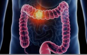 علائم گوارشی را ساده نگیرید/ هر خون‌ریزی هموروئید نیست